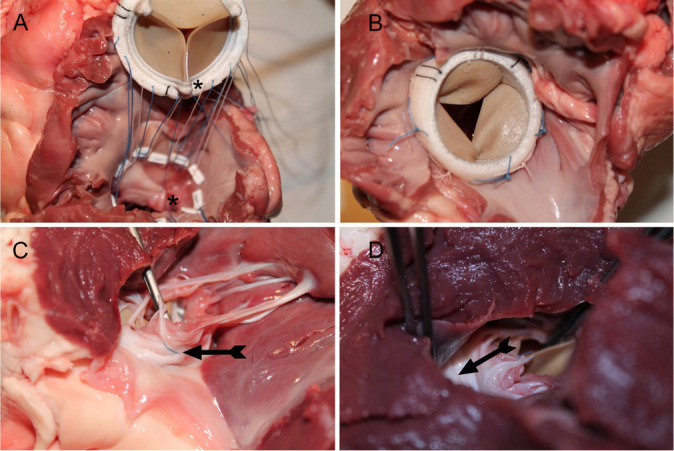 A Surgical Technique to Preserve the Subvalvular Apparatus in Patients Undergoing Mitral Valve Replacement for Severe Ischemic Regurgitation.