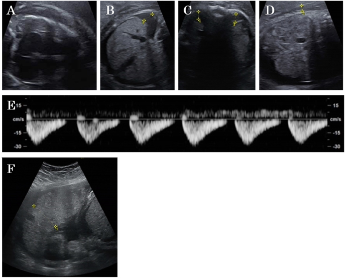 A case of placental multiple giant chorangioma leading to neonatal death from fetal hydrops.