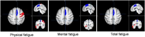 Regional gray matter volume correlates to physical and mental fatigue in healthy middle-aged adults