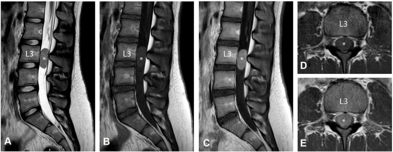 Intradural Extramedullary Ewing Sarcoma in an Adolescent Female.