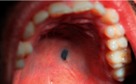 Blue Nevus of the Hard Palate: The Importance of a Careful Examination in an Emergency Setting.