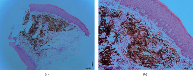 Blue Nevus of the Hard Palate: The Importance of a Careful Examination in an Emergency Setting.