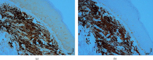 Blue Nevus of the Hard Palate: The Importance of a Careful Examination in an Emergency Setting.