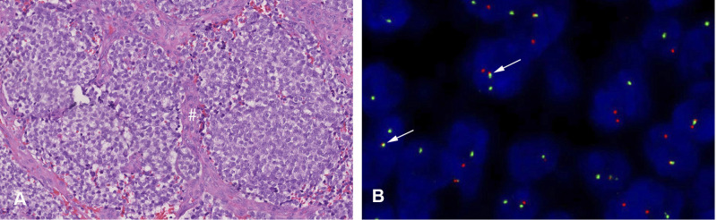 Intradural Extramedullary Ewing Sarcoma in an Adolescent Female.