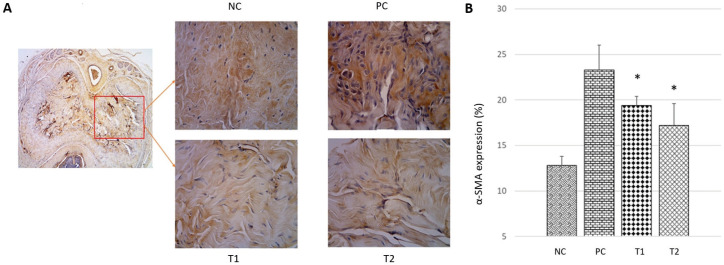 Umbilical Cord-Derived Mesenchymal Stem Cells Improve TGF-β, α-SMA and Collagen on Erectile Dysfunction in Streptozotocin-Induced Diabetic Rats.