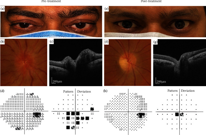 Retinal Surface Macrophage Changes in Thyroid Eye Disease before and after Treatment with Teprotumumab.