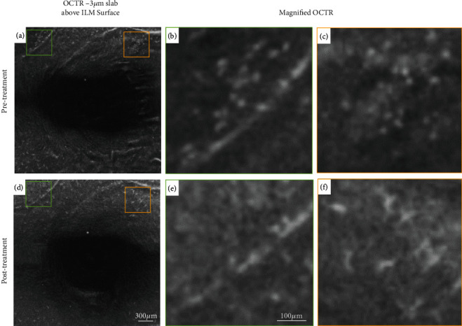 Retinal Surface Macrophage Changes in Thyroid Eye Disease before and after Treatment with Teprotumumab.