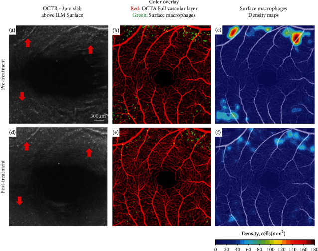 Retinal Surface Macrophage Changes in Thyroid Eye Disease before and after Treatment with Teprotumumab.