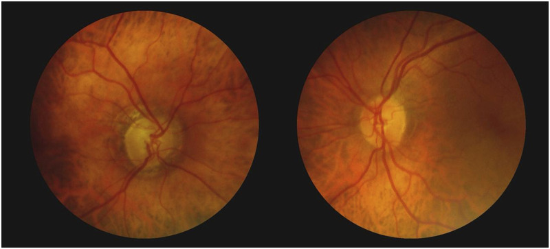 Glaucomatous Type Cupping Caused by Internal Carotid Artery Compression: a Case Report.