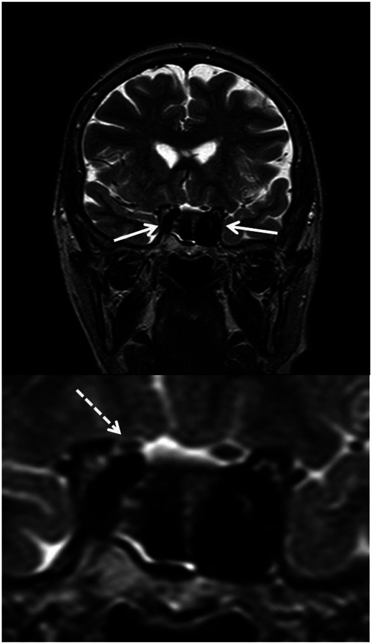 Glaucomatous Type Cupping Caused by Internal Carotid Artery Compression: a Case Report.