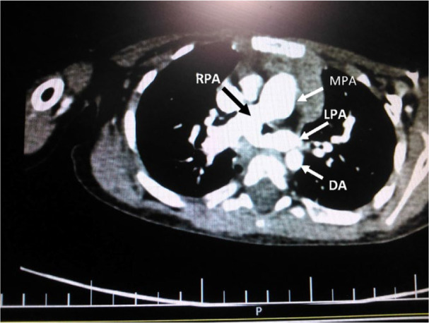 Pulmonary Artery Sling Associated with Stridor from Early Infancy: A Case Report.