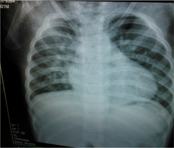 Pulmonary Artery Sling Associated with Stridor from Early Infancy: A Case Report.