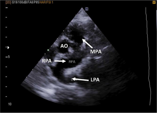 Pulmonary Artery Sling Associated with Stridor from Early Infancy: A Case Report.