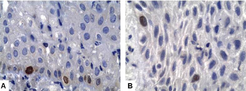 Expression of epithelial growth factors and of apoptosis-regulating proteins, and presence of CD57+ cells in the development of inflammatory periapical lesions.