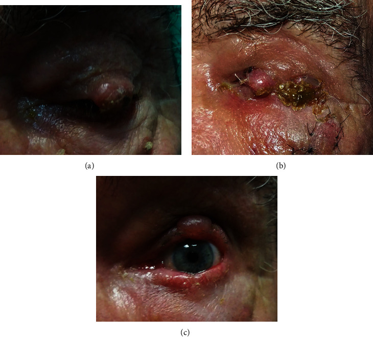 The New Face of the Switch Flap in the Reconstruction of a Large Upper Eyelid Defect.