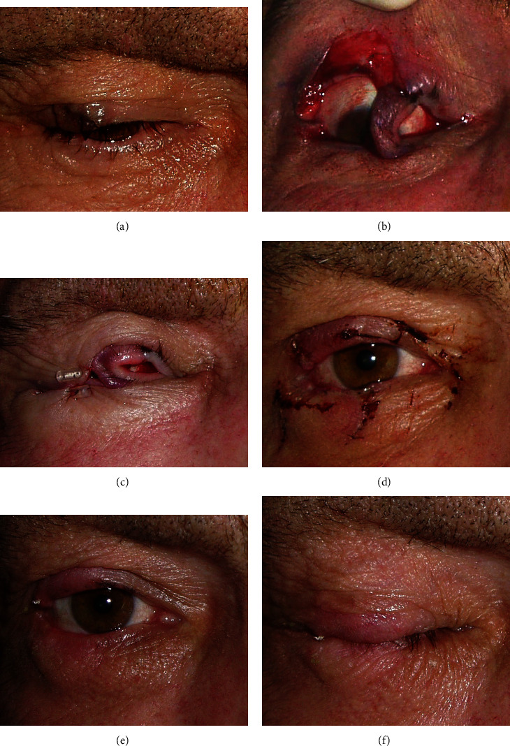 The New Face of the Switch Flap in the Reconstruction of a Large Upper Eyelid Defect.