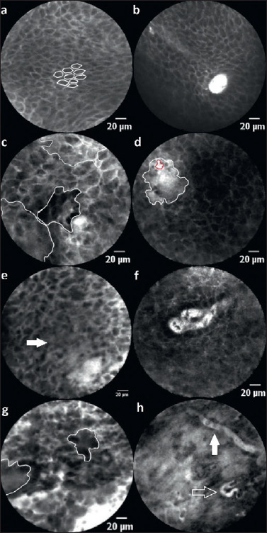 Systematic interpretation of confocal laser endomicroscopy: larynx and pharynx confocal imaging score.