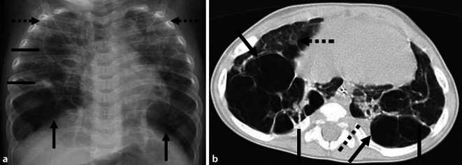 [Chest X-rays in children and adolescents : Indications and limitations].