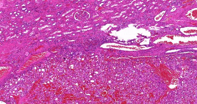 [Epithelioid angiomyolipoma of the kidney after successfully treated malignant melanoma].