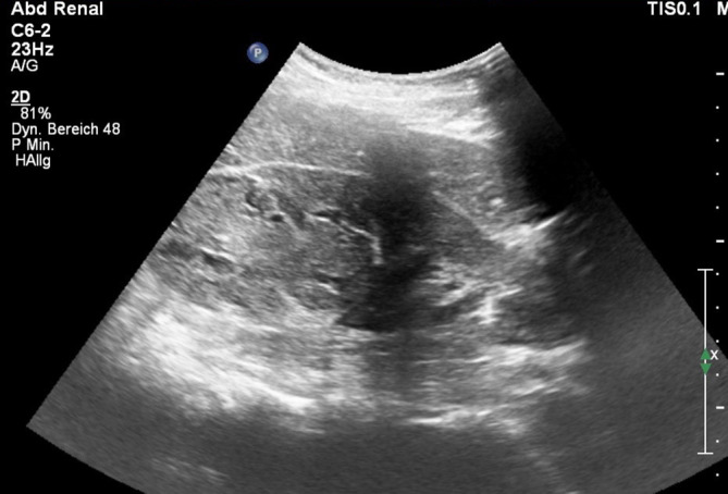 [Epithelioid angiomyolipoma of the kidney after successfully treated malignant melanoma].