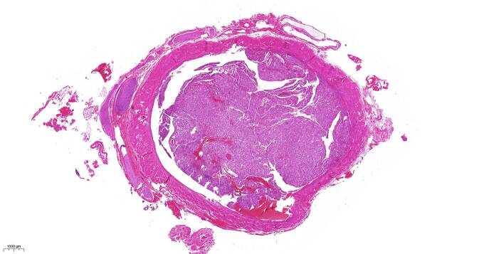 [Epithelioid angiomyolipoma of the kidney after successfully treated malignant melanoma].