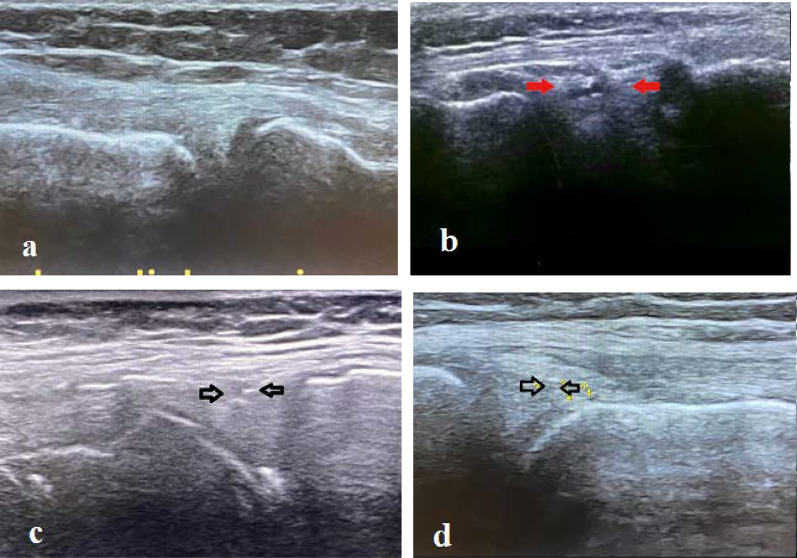 Role of point-of-care ultrasonography (POCUS) in the diagnosing of acute medial meniscus injury of knee joint.