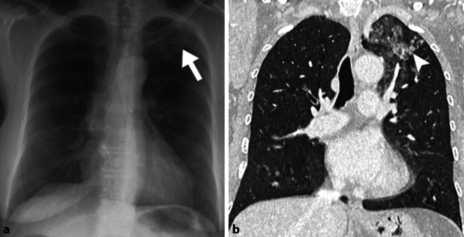 [Chest radiography findings in diffuse parenchymal lung diseases].