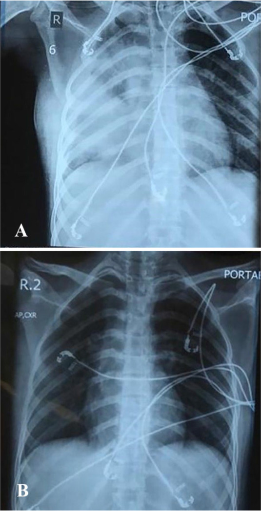 Reversible Acute Lung Injury due to Bleomycin.