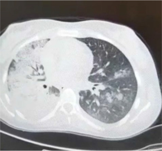 Reversible Acute Lung Injury due to Bleomycin.