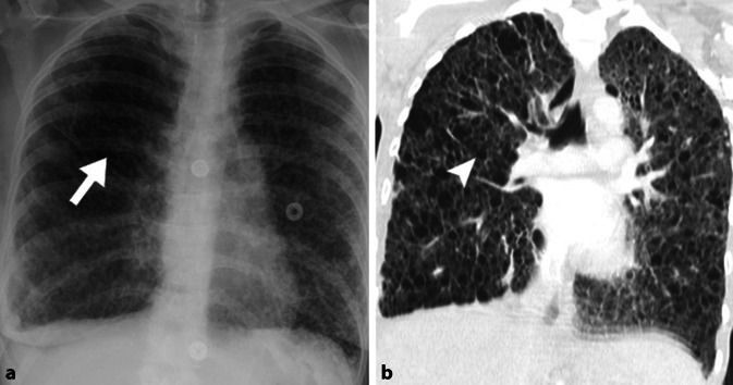 [Chest radiography findings in diffuse parenchymal lung diseases].