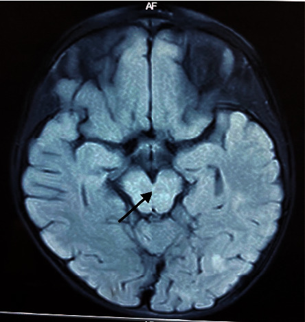 Acute Disseminated Encephalomyelitis Presenting as Bilateral Ptosis in a Sri Lankan Child.