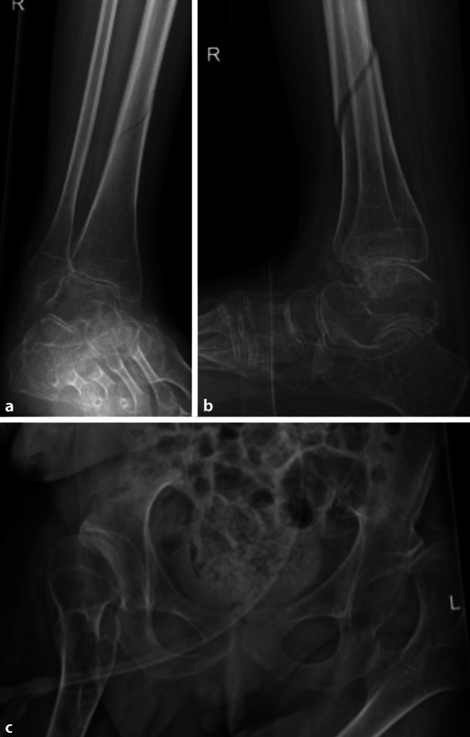 [Medicine for people with disabilities : Special features of trauma surgical care of extremity injuries in people with severe mental and physical disabilities].