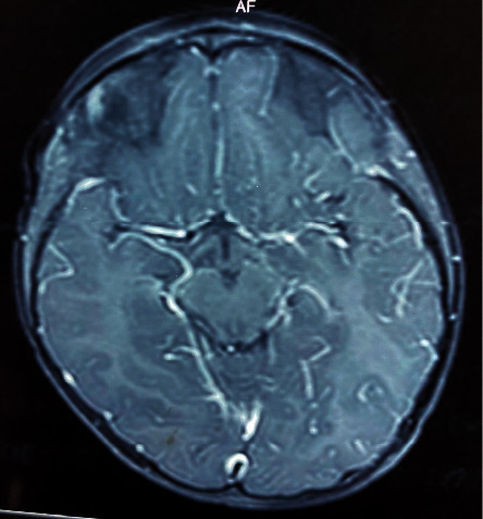 Acute Disseminated Encephalomyelitis Presenting as Bilateral Ptosis in a Sri Lankan Child.