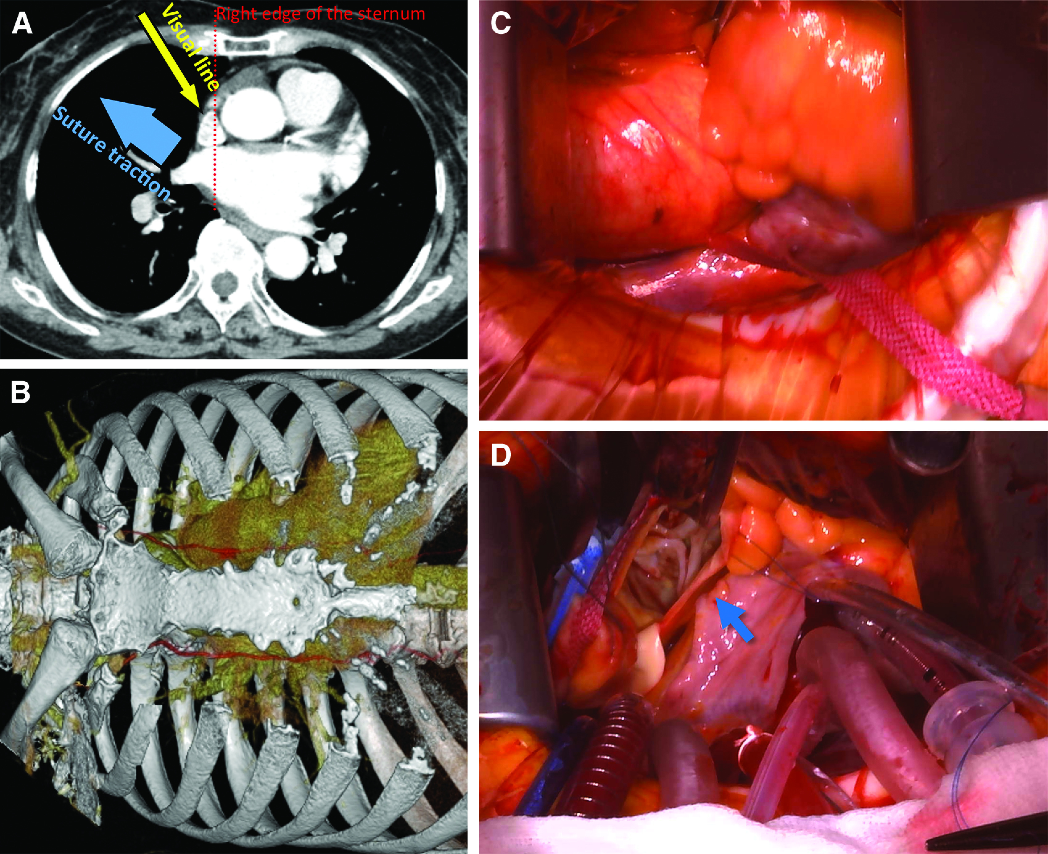 Safety and Applicability of Continuous Retrograde Cardioplegia in Minimally Invasive Aortic Valve Replacement: New Approaches.