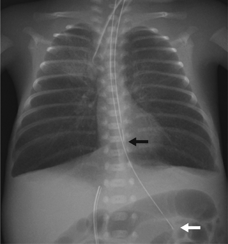 Bedside Ultrasonography in Evaluating Mediastinum Leakage in an Extremely-Low-Birth-Weight Infant with Esophageal Perforation.