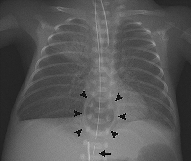 Bedside Ultrasonography in Evaluating Mediastinum Leakage in an Extremely-Low-Birth-Weight Infant with Esophageal Perforation.