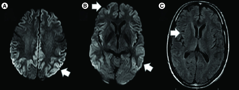 COVID-19-associated encephalitis or Creutzfeldt-Jakob disease: a case report.