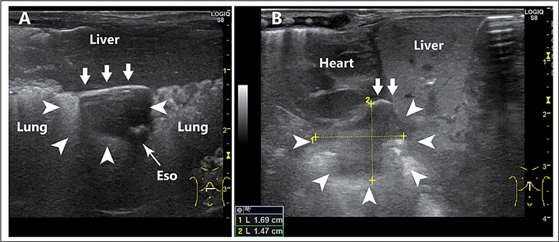 Bedside Ultrasonography in Evaluating Mediastinum Leakage in an Extremely-Low-Birth-Weight Infant with Esophageal Perforation.