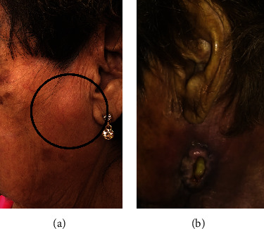 Primary Lymphoepithelioma-Like Carcinoma of the Conjunctiva Metastatic to Regional Lymph Nodes and Parotid Gland in a Mexican Patient.