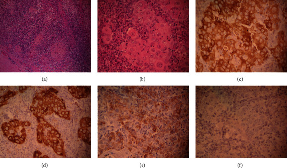 Primary Lymphoepithelioma-Like Carcinoma of the Conjunctiva Metastatic to Regional Lymph Nodes and Parotid Gland in a Mexican Patient.