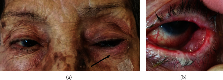 Primary Lymphoepithelioma-Like Carcinoma of the Conjunctiva Metastatic to Regional Lymph Nodes and Parotid Gland in a Mexican Patient.