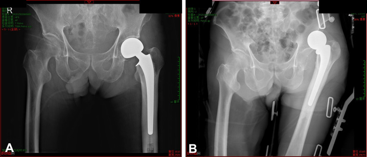 Multivariable Analysis of Risk Factors Affecting Dislocation After Bipolar Hemiarthroplasty in Patients with Femoral Neck Fracture.