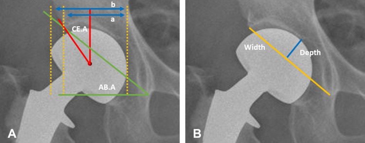 Multivariable Analysis of Risk Factors Affecting Dislocation After Bipolar Hemiarthroplasty in Patients with Femoral Neck Fracture.