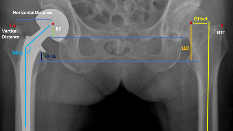 Multivariable Analysis of Risk Factors Affecting Dislocation After Bipolar Hemiarthroplasty in Patients with Femoral Neck Fracture.