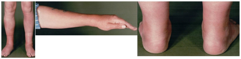 Musculoskeletal Manifestations of Sarcoidosis.