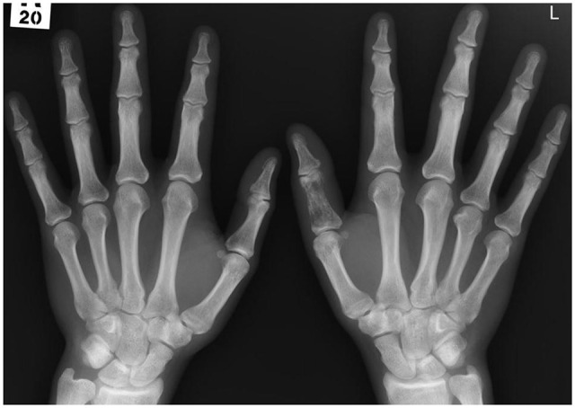Musculoskeletal Manifestations of Sarcoidosis.