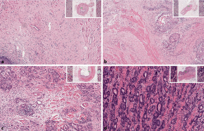 [Grading of tumor regression of gastrointestinal carcinomas after neoadjuvant therapy].