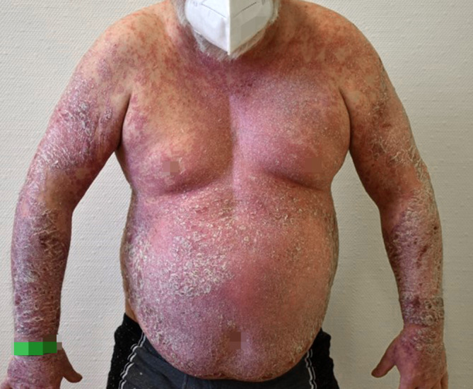 [Erythrodermic psoriasis after COVID-19].