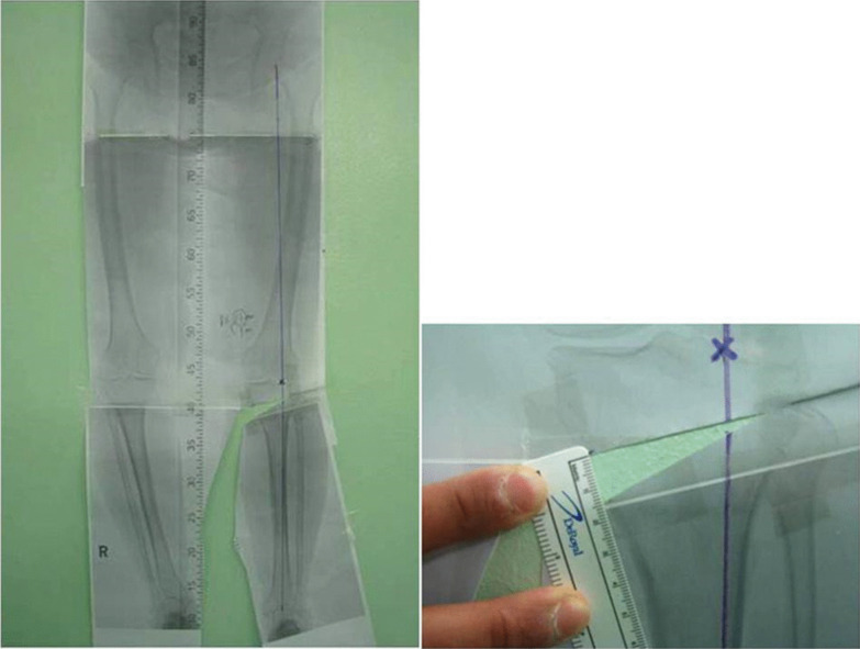 How to achieve an optimal alignment in medial opening wedge high tibial osteotomy?