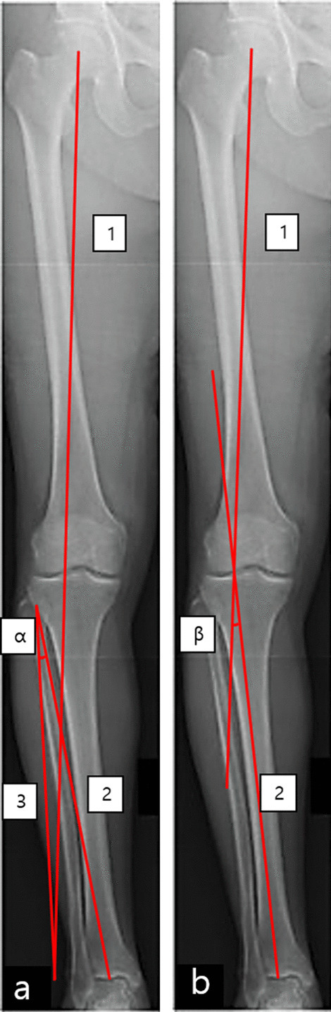 How to achieve an optimal alignment in medial opening wedge high tibial osteotomy?